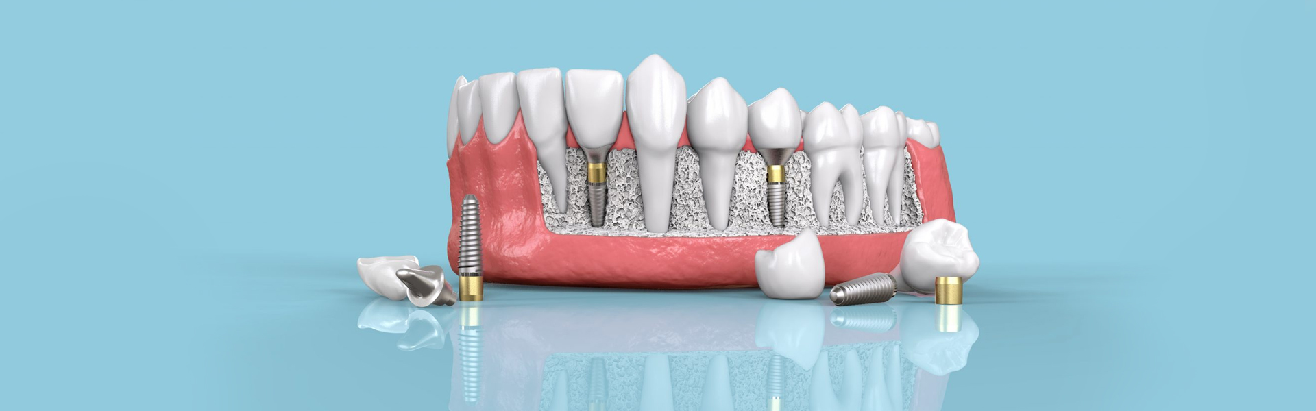 Dental Implant Procedure: Your In-Depth Step By Step Guide